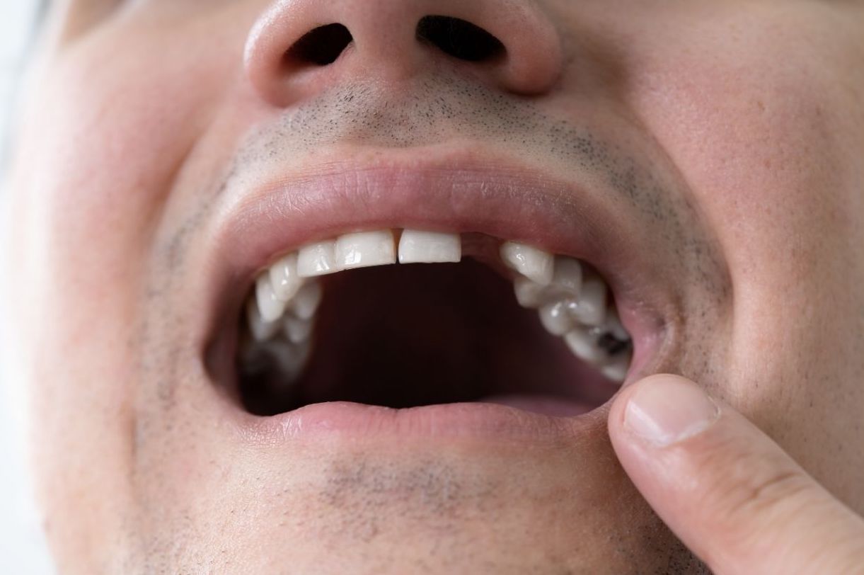 Pop Out Tooth Dental Health FAQ - Dentist in Lincoln Park, Downriver, MI | Dr ...